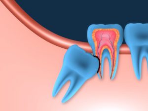 'impacted wisdom teeth'