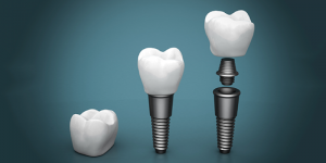 'dental implants'